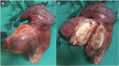 Successful Radical Pneumonectomy for a Primitive Neuroendodermal Tumor in the Lung: A Case Report and Review of the Literature